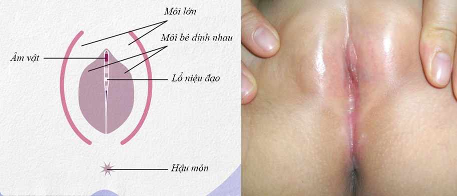 Hình ảnh dính môi bé ở bé gái