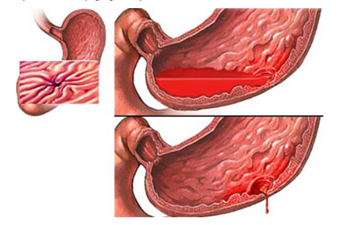 Các thể lâm sàng và loét dạ dày tá tràng - ảnh 3