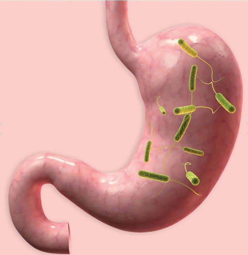 Nhiễm H.pylori và các bệnh lý liên quan với phương pháp chẩn đoán xâm nhập - ảnh 1