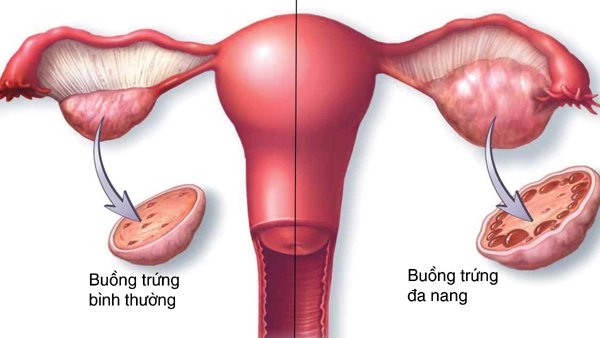 Bệnh nội tiết ở phụ nữ nguyên nhân vô sinh hiếm muộn - ảnh 1