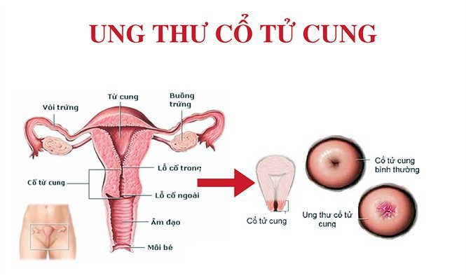 Bệnh thường gặp ở cổ tử cung