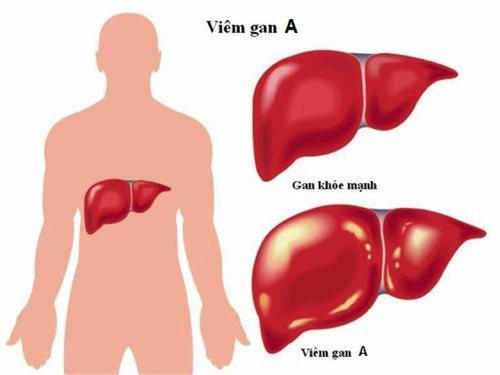 Viêm gan A