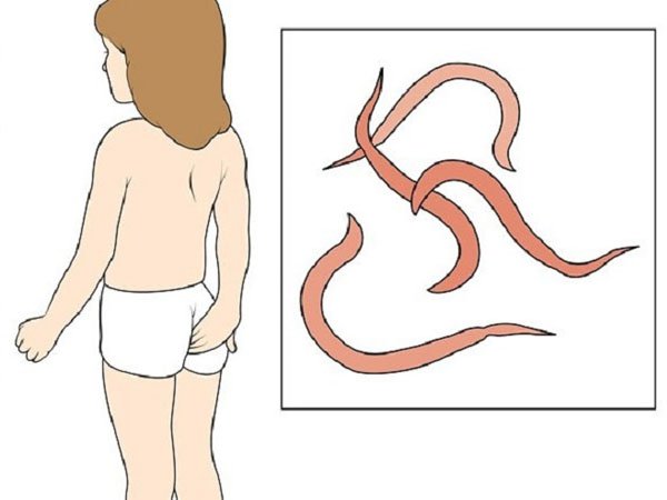 Những điều cần biết về bệnh ngứa hậu môn - ảnh 3