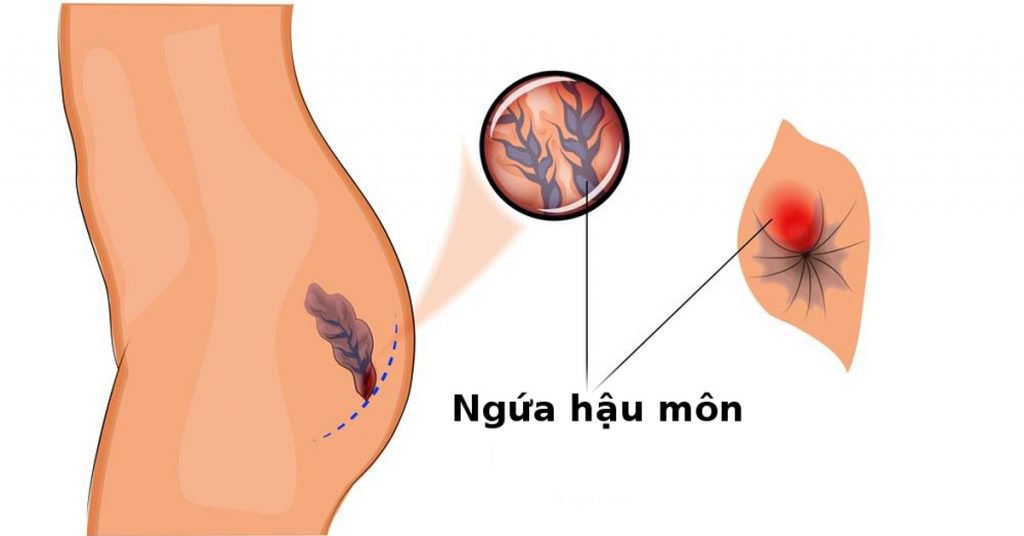 Những điều cần biết về bệnh ngứa hậu môn - ảnh 1