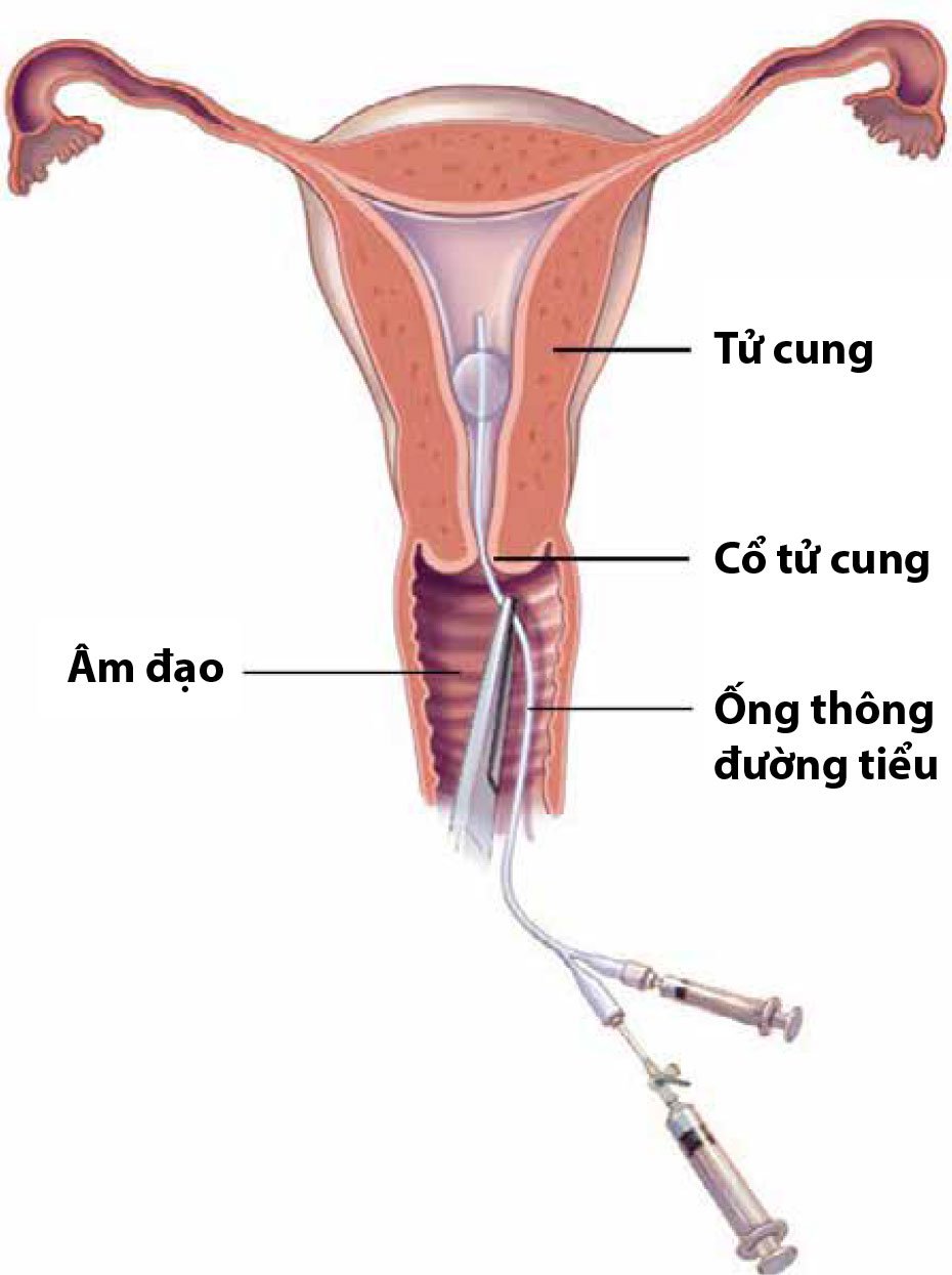 Chụp tử cung - vòi tử cung