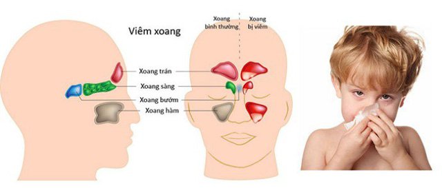 Trẻ viêm xoang