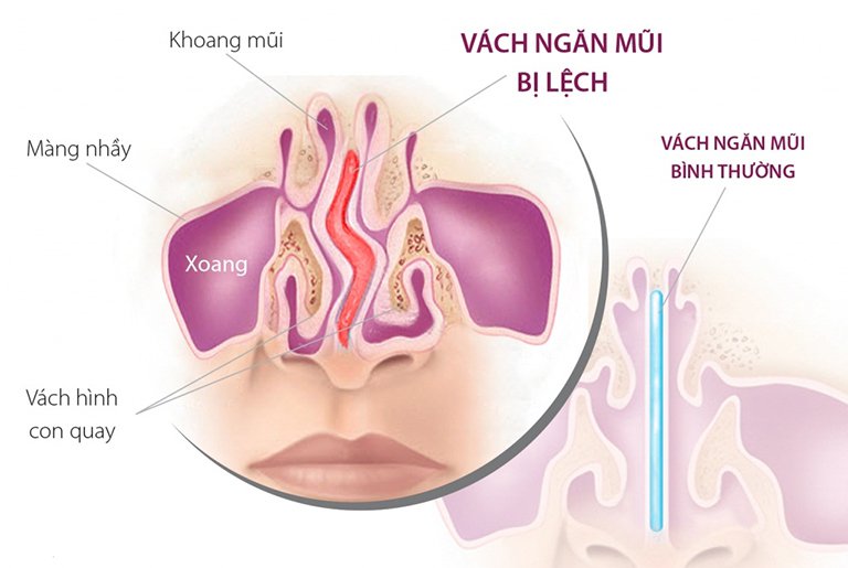 Vẹo vách ngăn mũi