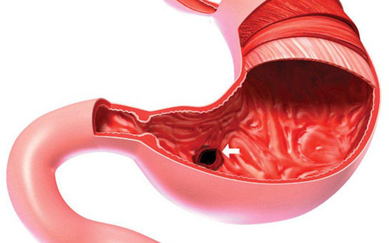 Cắt đoạn điều trị viêm loét dạ dày - tá tràng - ảnh 1