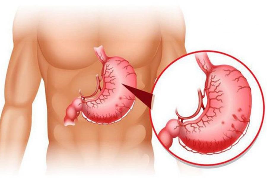 Xuất huyết tiêu hóa