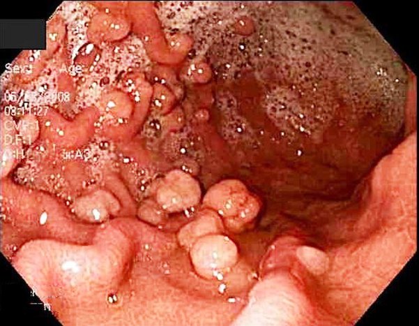Đa polyp tuyến gia đình