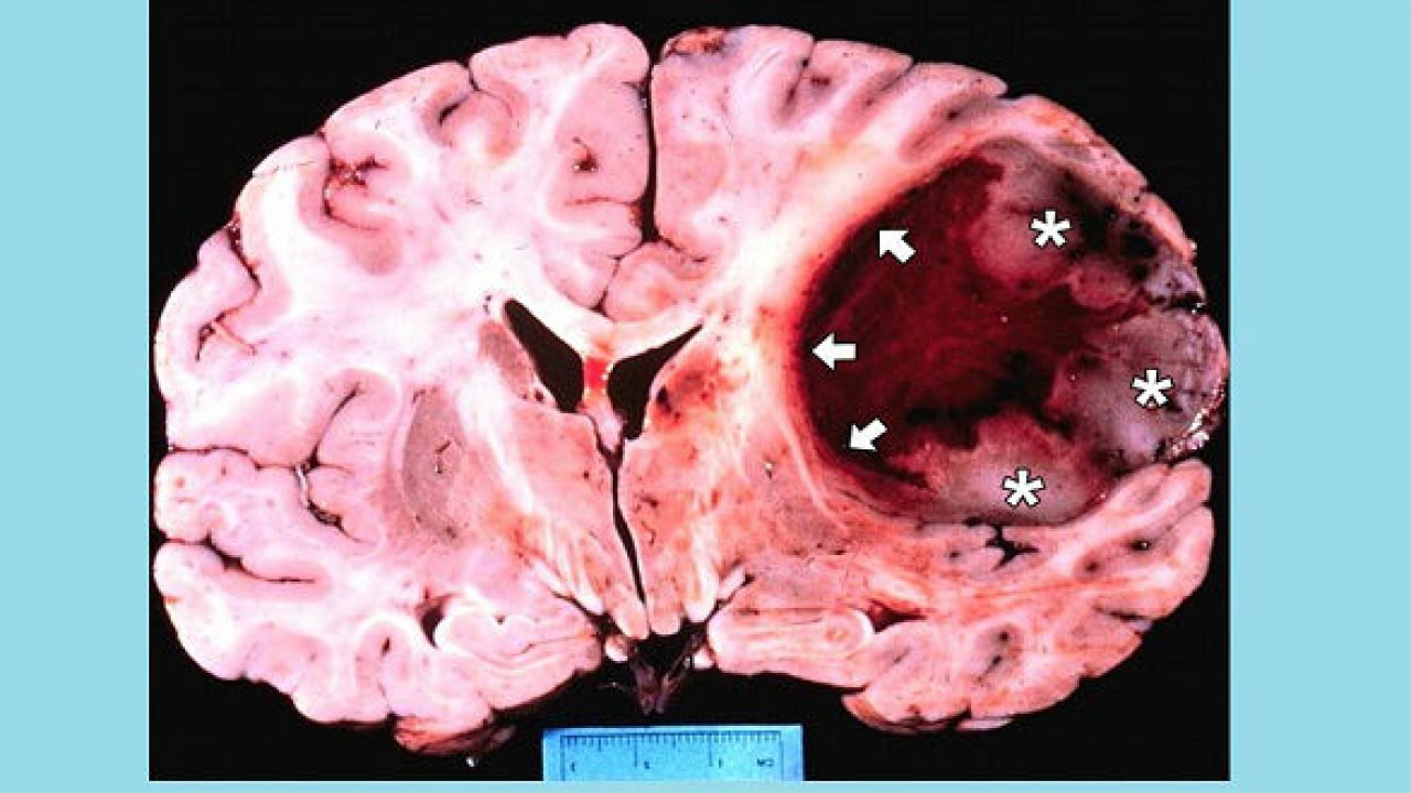 U nguyên bào thần kinh đệm (Glioblastoma)