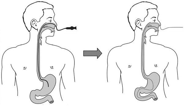 Ưu điểm của nội soi tiêu hóa qua đường mũi - ảnh 1