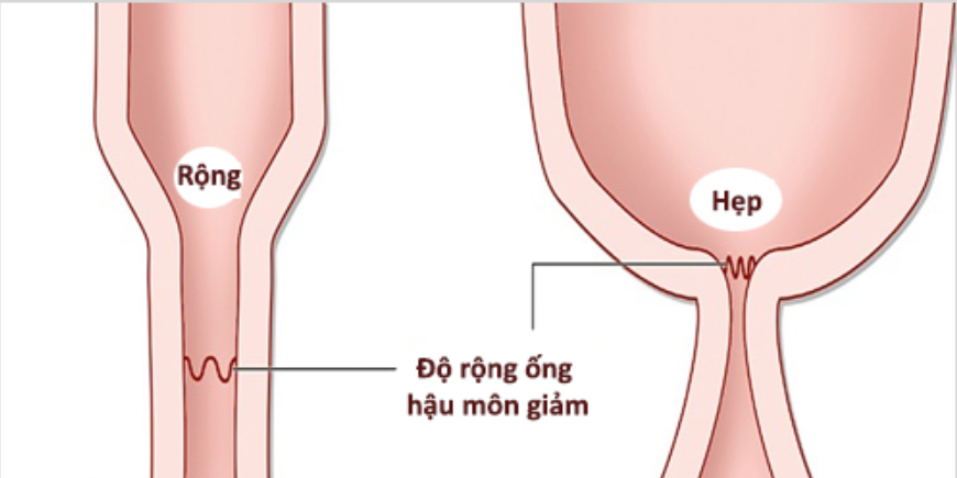 Nong hậu môn cho trẻ sơ sinh cần lưu ý những gì? - ảnh 1