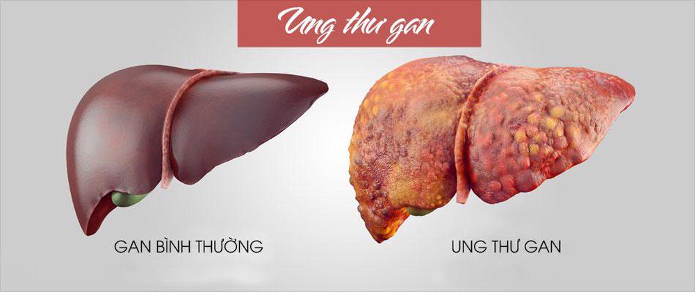 Các loại ung thư gan thường gặp