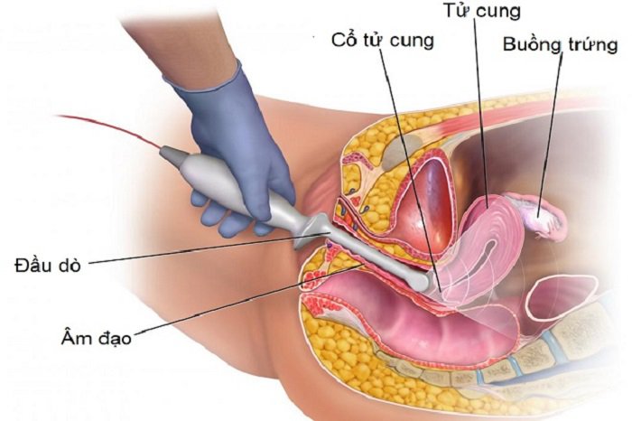 siêu âm đầu dò âm đạo