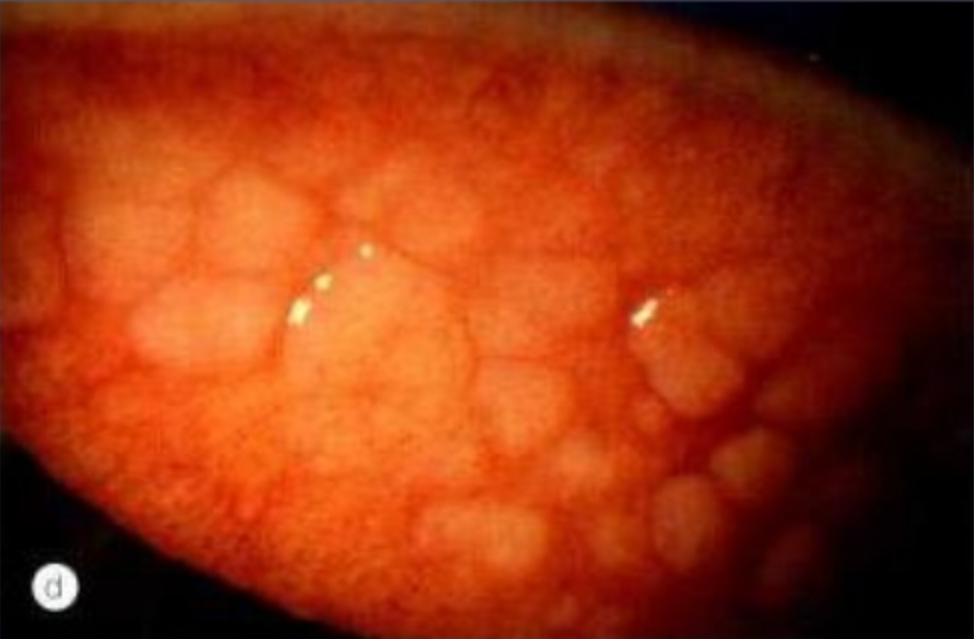 Viêm kết mạc nhu gai khổng lồ