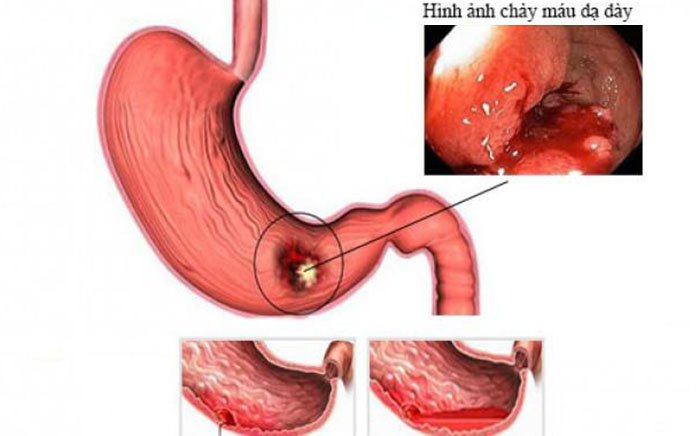 Bệnh loét dạ dày tá tràng có chỉ định mổ - ảnh 3