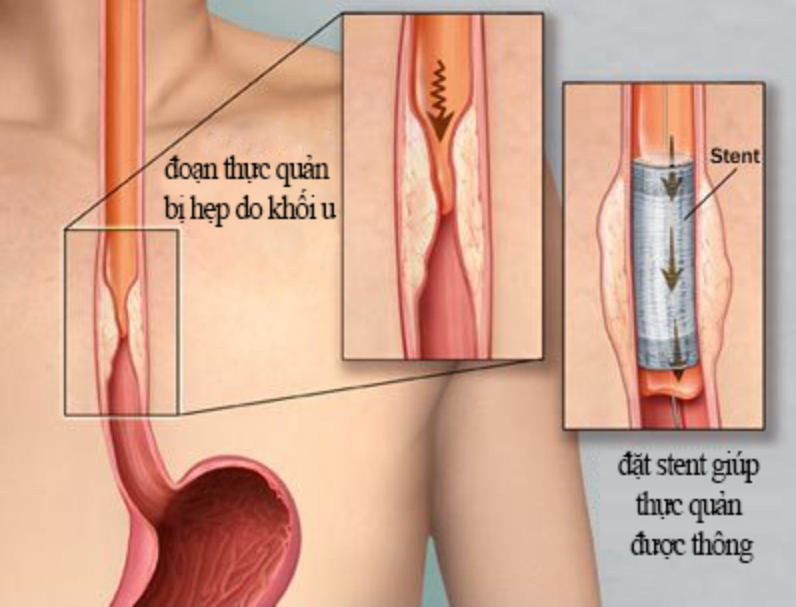 Đặt stent điều trị ung thư thực quản giai đoạn cuối - ảnh 2