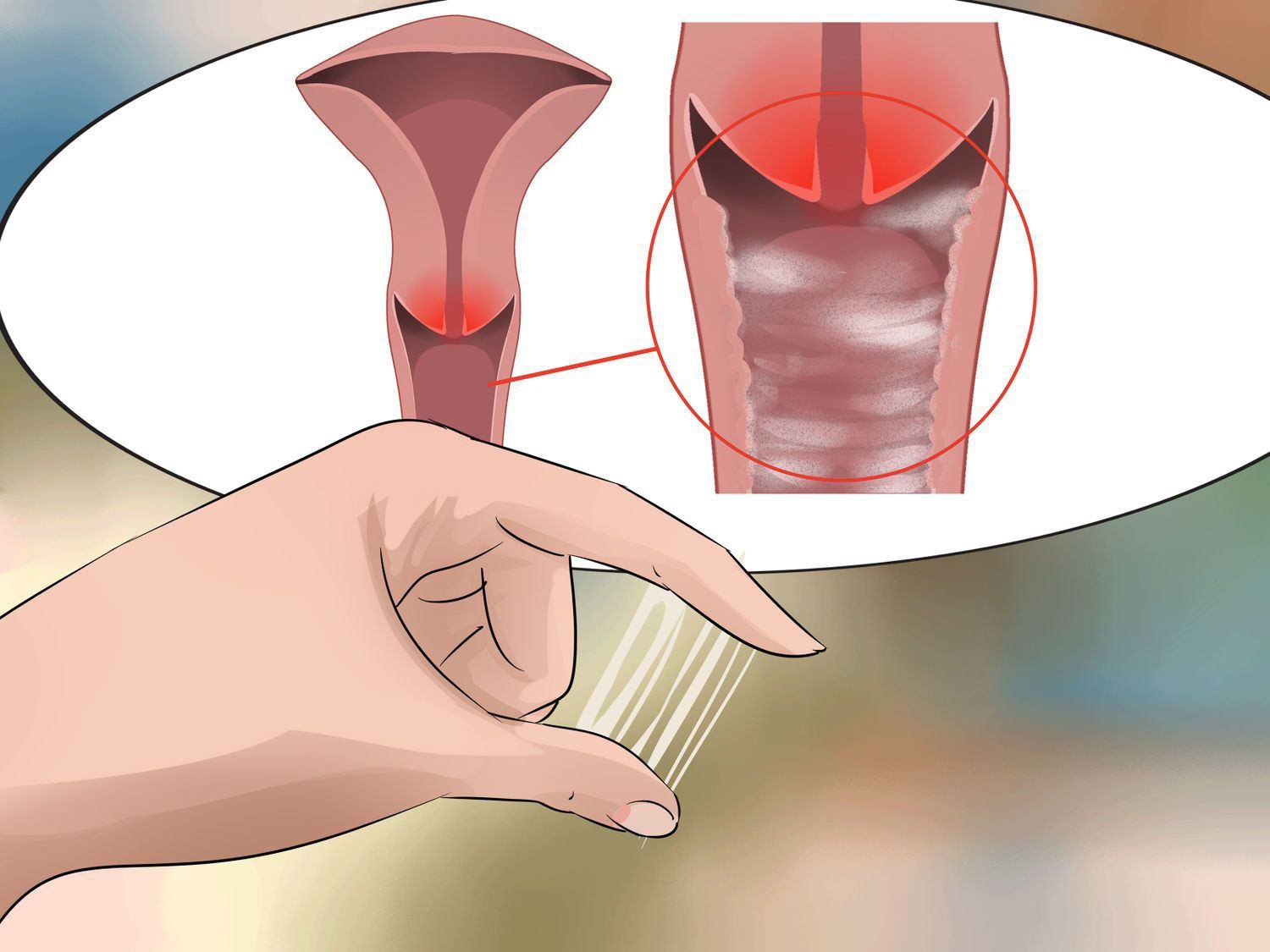 Viêm nhiễm âm đạo