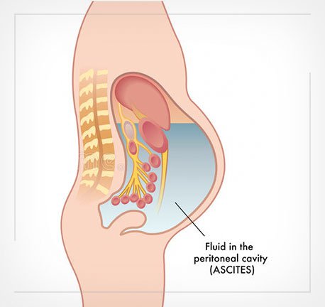 sa trực tràng có những mức độ nào? - ảnh 1