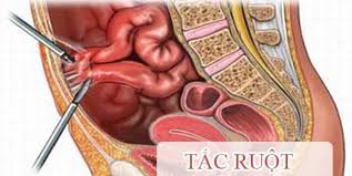 Tắc ruột