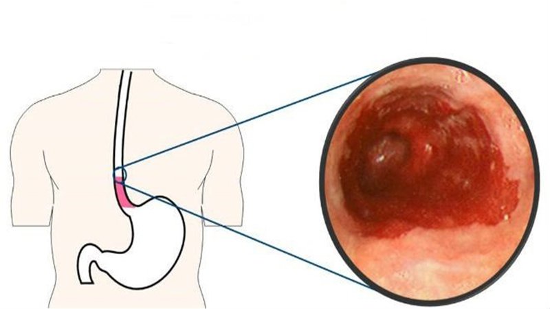 Polyp thực quản: Khi nào cần phẫu thuật? - ảnh 1