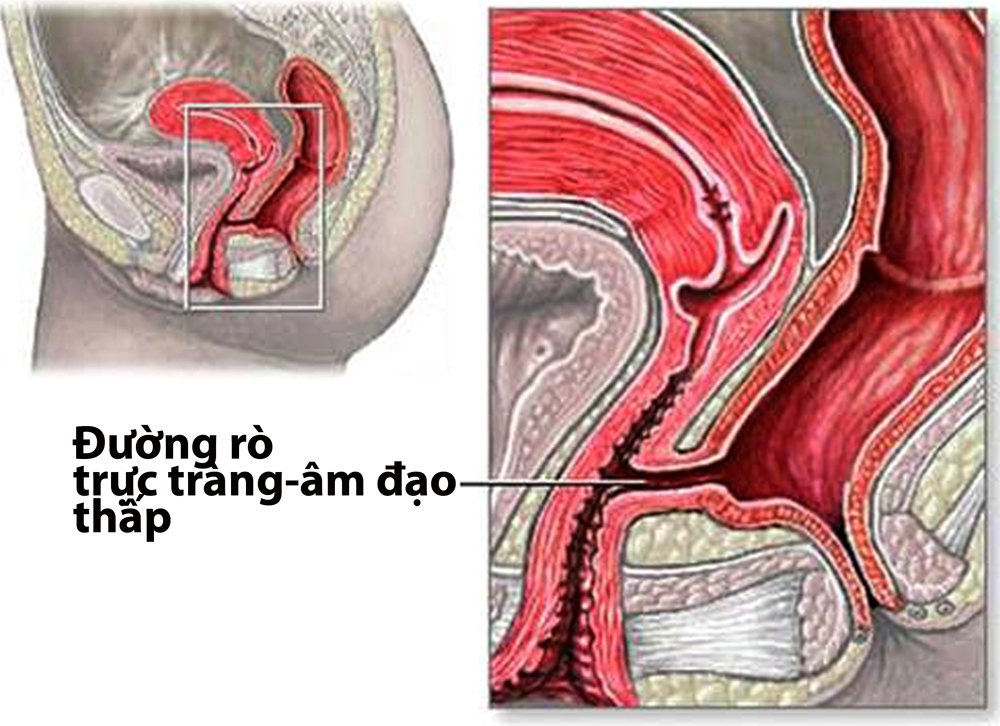 Tìm hiểu kỹ thuật đóng rò trực tràng âm đạo
