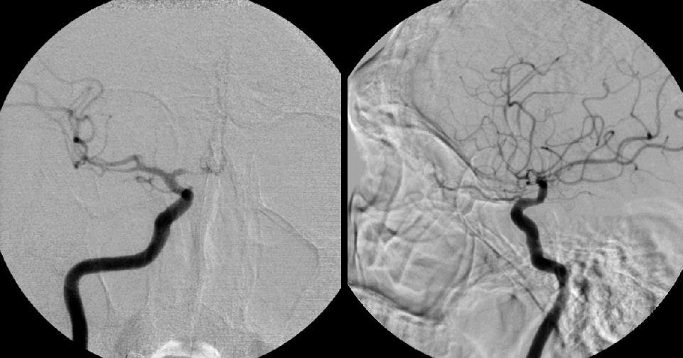 Điều trị hẹp tắc thực quản dưới hướng dẫn của chụp số hóa xóa nền