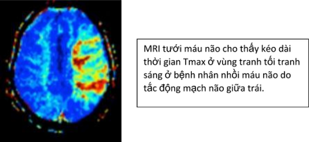 Tưới máu não
