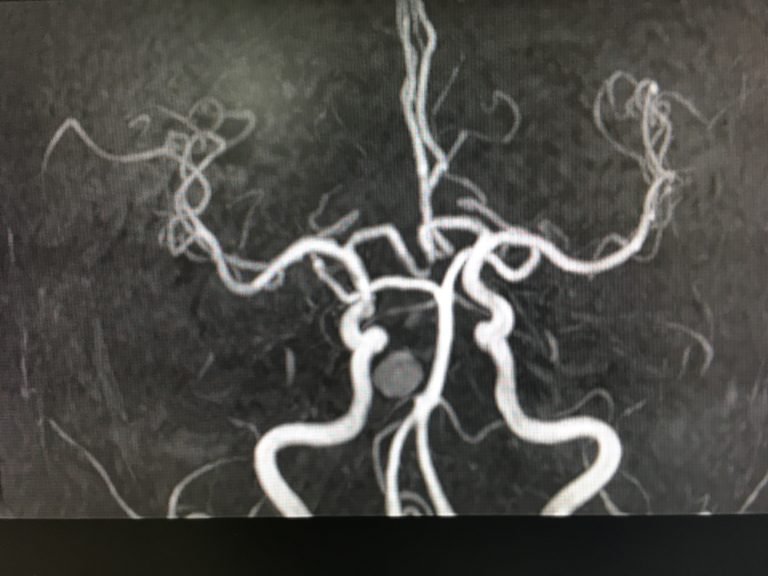 Hình ảnh cộng hưởng từ động mạch não