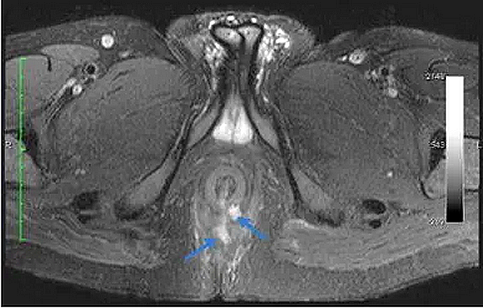 Axial T2 SPAIR: ổ tụ dịch gian cơ thắt (trước) và ngoài cơ thắt (sau)