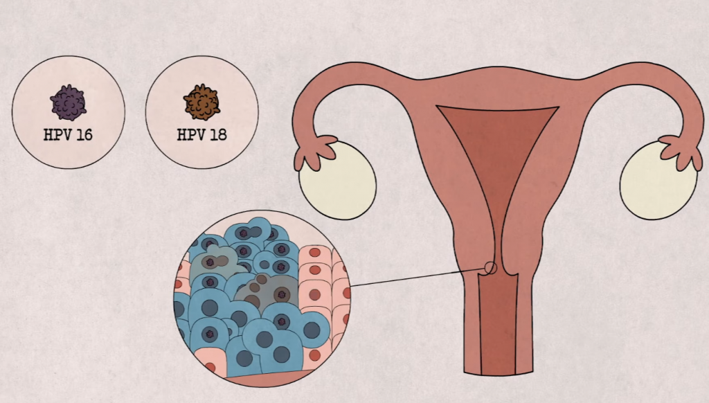 HPV ung thư cổ tử cung
