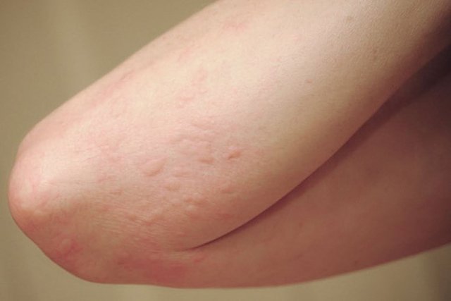 Dị ứng thời tiết nổi mề đay