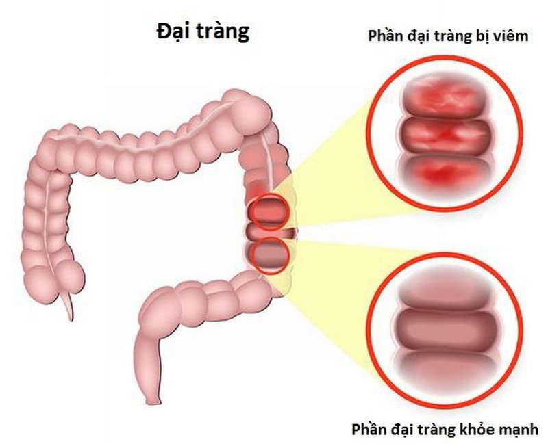 Viêm đại tràng