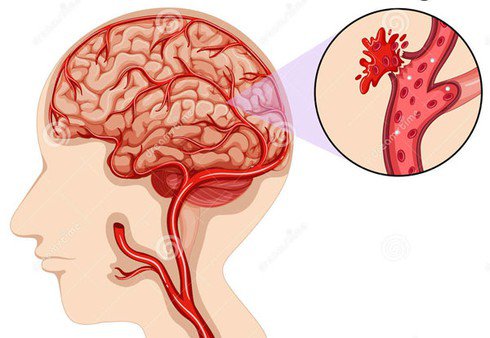 Nguyên nhân tăng huyết áp nặng phải cấp cứu - ảnh 1