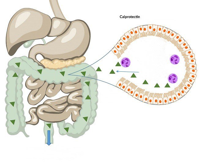 Xét nghiệm Calprotectin