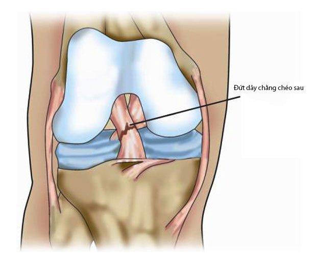 Đứt dây chằng chéo sau