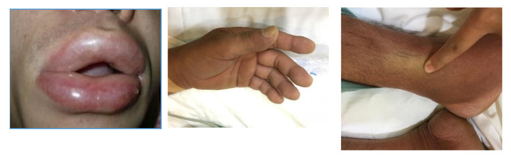 Ban giãn mạch ở bệnh nhân sốc phản vệ