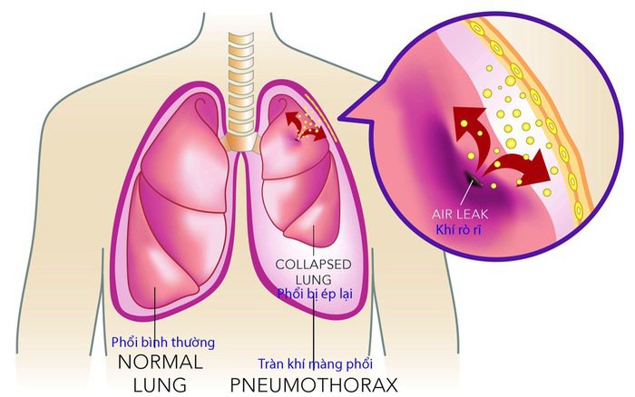 Tiêm xơ giãn tĩnh mạch thực quản - ảnh 2