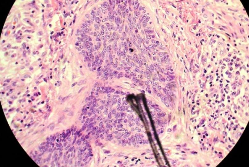 Ung thư biểu mô vảy là dạng thứ 2 của ung thư cổ tử cung