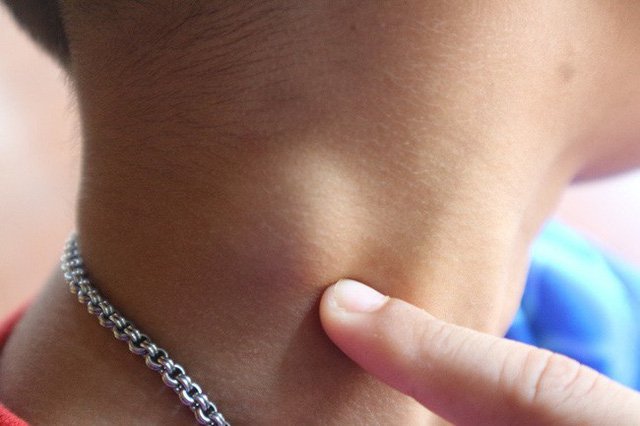 Ảnh hưởng của túi thừa thực quản - ảnh 2