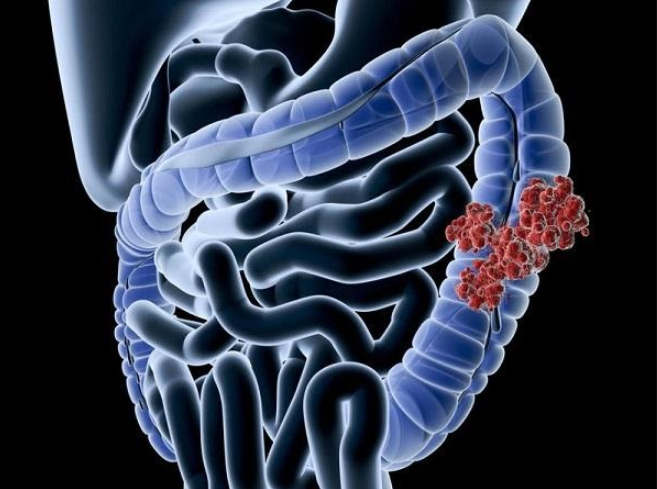 Ung thư đại tràng