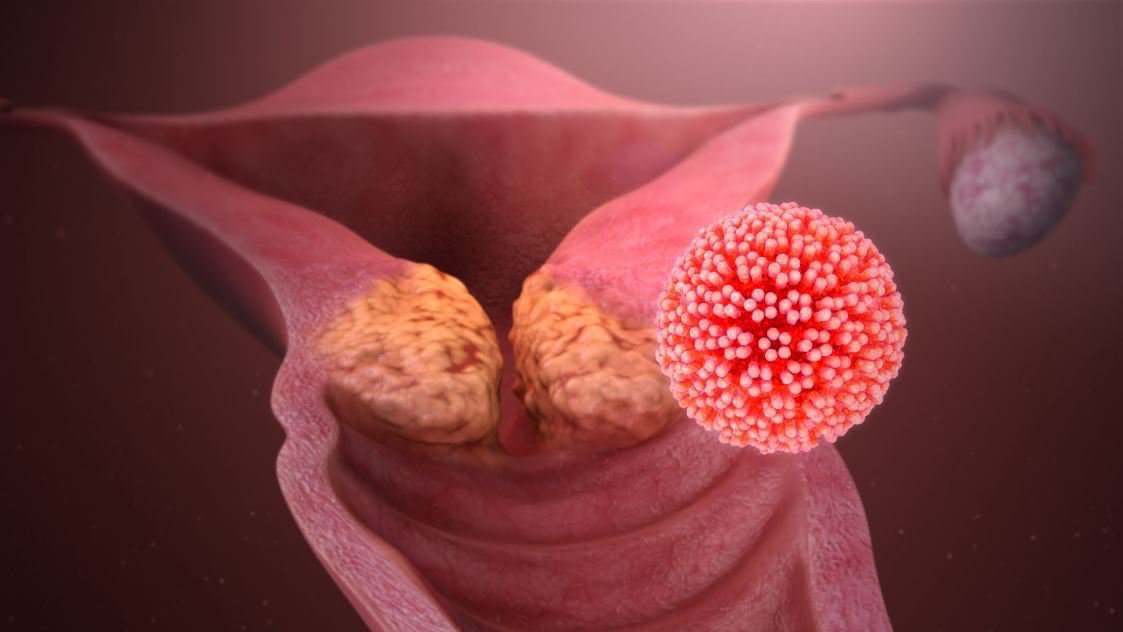 Ung thư cổ tử cung HPV