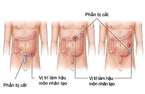 Xử trí vết thương hậu môn trực tràng - ảnh 2