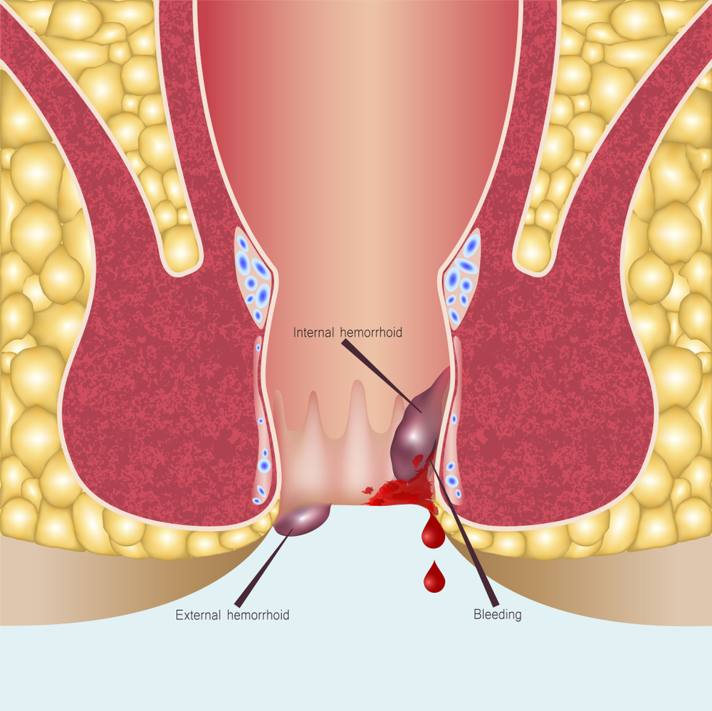Xử trí vết thương hậu môn trực tràng - ảnh 1
