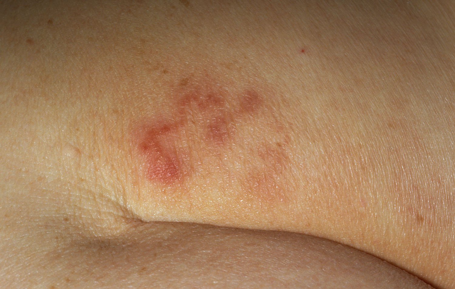 Bệnh giun đầu gai