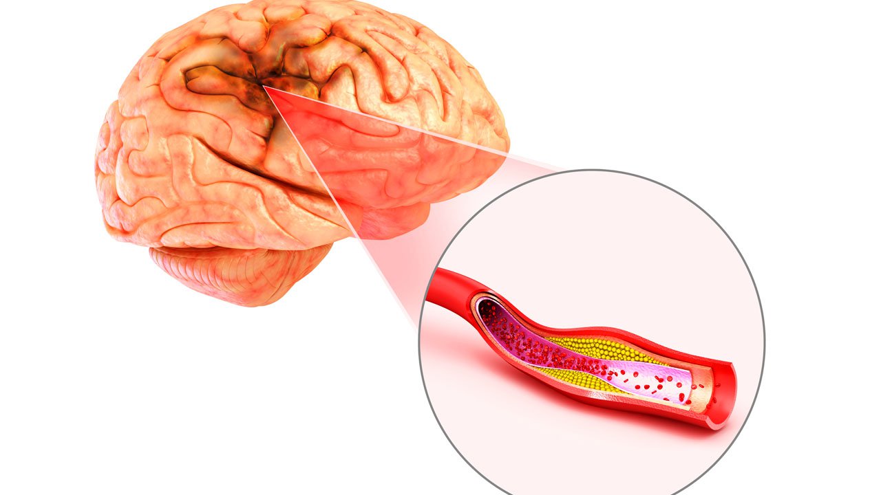 Can thiệp động mạch đốt sống bằng stent như thế nào? - ảnh 2