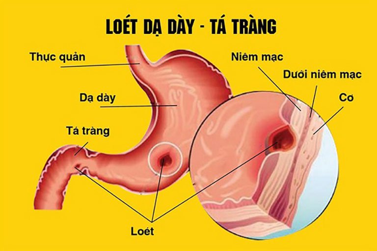 Viêm - loét dạ dày tá tràng