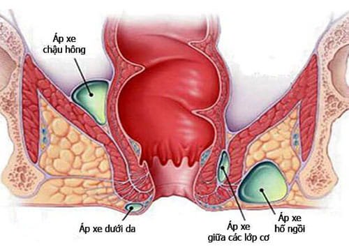 Áp xe hậu môn trực tràng: Phân loại và cách xử trí - ảnh 1