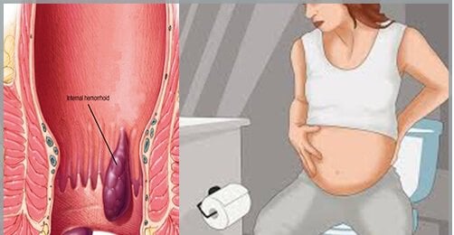 Tắc mạch trĩ là gì? Điều trị như thế nào? - ảnh 2